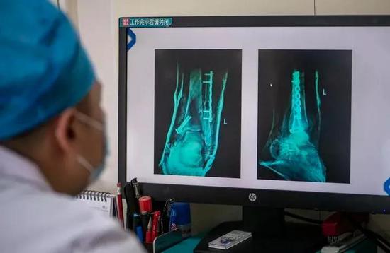 云南省曲靖市第一人民医院关节与运动医学科施璟医生在查看使用液态金属“外骨骼”固定的X光片(图片来自网络)